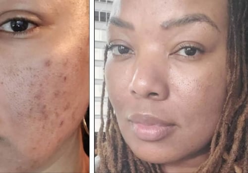 Aftercare for Chemical Peels: Achieving Optimal Results